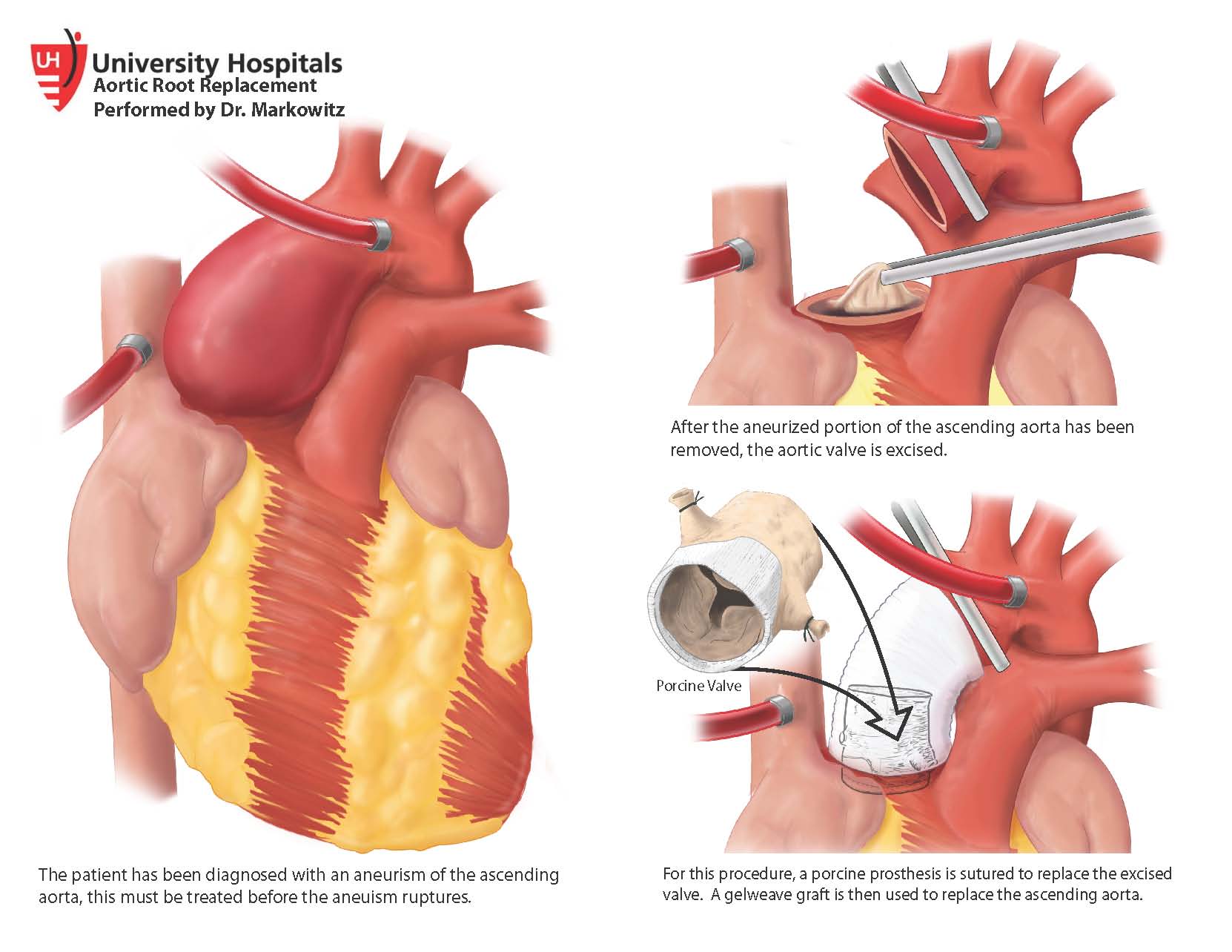 Что такое шунтирование сердца и сосудов. Коронарное шунтирование сосудов сердца. Шунтирование операция. Аорта коронарное шунтирование. Операция на сердце шунтирование.